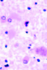 Variant Creutzfeldt-Jakob Disease Death, United States