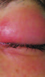Ocular Vaccinia Infection in Laboratory Worker, Philadelphia, 2004