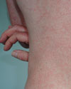  Chikungunya Infection in Travelers