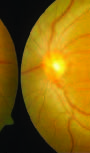 Ophthalmic Complications of Dengue