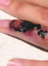 Cutaneous Anthrax, Belgian Traveler
