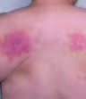 Mycobacterium intermedium Granulomatous Dermatitis from Hot Tub Exposure