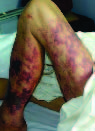 Human Streptococcus suis Outbreak, Sichuan, China
