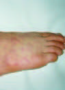 Japanese Spotted Fever, South Korea