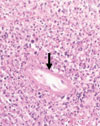 Histologic Features and Immunodetection of African Tick-bite Fever Eschar