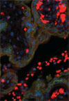 Seasonal Influenza A (H1N1) Infection in Early Pregnancy and Second Trimester Fetal Demise