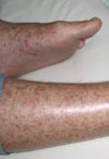  Rickettsia honei Infection in Human, Nepal, 2009