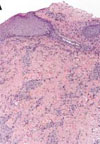 Blastomycosis in Man after Kinkajou Bite