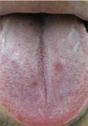 Eschar-associated Spotted Fever Rickettsiosis, Bahia, Brazil