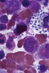 Disseminated Infection Caused by Novel Species of <em>Microsporidium</em>, Thailand