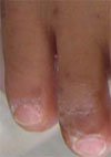 Hand, Foot, and Mouth Disease Caused by Coxsackievirus A6, Japan, 2011