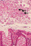 Risk Factors for Intestinal Invasive Amebiasis in Japan, 2003–2009