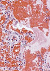 Fatal Human Co-infection with <em>Leptospira</em> spp. and Dengue Virus, Puerto Rico, 2010