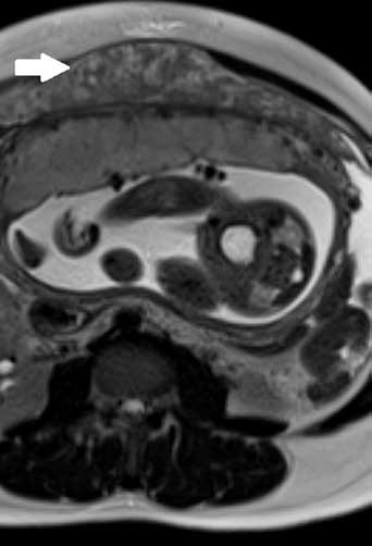 Peritoneal Tuberculosis in a Pregnant Woman from Haiti, United States