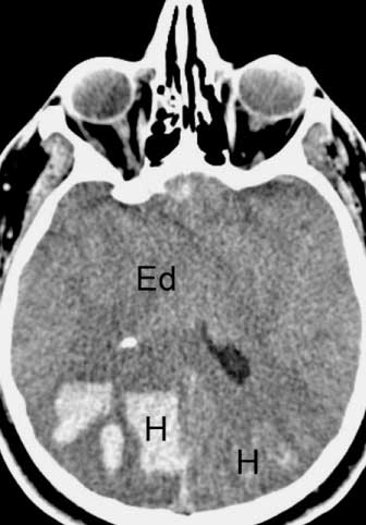 Fatal Influenza A(H1N1)pdm09 Encephalopathy in Immunocompetent Man