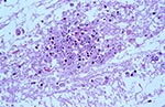 Thumbnail of Neuronal necrosis with infiltrates of microglia and polymorphonuclear leukocytes. Hematoxylin-eosin staining. Original magnification, X100.