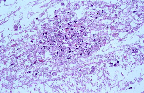 Neuronal necrosis with infiltrates of microglia and polymorphonuclear leukocytes. Hematoxylin-eosin staining. Original magnification, X100.