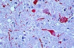 Thumbnail of Positive staining of viral antigens in neurons and neuronal processes. Immunoalkaline phosphate staining, naphthol fast red substrate with light hematoxylin counterstain. Original magnification, X100.