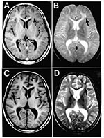 Thumbnail of MRI scans of the brain at the time of presentation in the neurology clinic (A and B) and 3 months later (C and D). Panels A and C are T1-weighted images; B and D are T2-weighted images. The initial MRI scan (A and B) reveals a focal abnormality in the subcortical white matter of the left frontal lobe, consisting of a hypointense signal on the T1-weighted image (arrow in A) and a hyperintense signal on the T2-weighted image (arrow in B). In the followup scan, the focal abnormality in