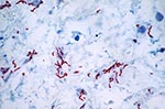 Thumbnail of Immunohistochemistry for Treponema pallidum in an area with few inflammatory infiltrates and multiple spirochetes.
