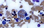 Thumbnail of Hemophagocytosis in the bone marrow of an 18-year-old woman with Epstein-Barr virus (EBV)-associated hemophagocytic lymphohistiocytosis. The patient visited her physician in September 1997 with pharyngitis and an elevated heterophile agglutinin titer. She was diagnosed with infectious mononucleosis, and her symptoms resolved in 2 weeks. Approximately 2 months later, she had persistent, spiking fevers and became jaundiced; her immunoglobulin (Ig) M to EBV capsid antigen was positive;