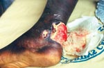 Thumbnail of Buruli ulcer on left ankle.