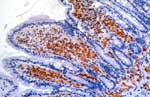 Thumbnail of Demonstration of Tropheryma whipplei by immuno-histochemistry in the lamina propria of the villous tips. Bacilli are revealed in foamy macrophage cytoplasm as red-brown deposits (polyclonal rabbit.