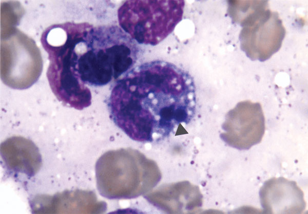 Bone marrow examination (Wright's stain x1000). Intraleukocytic morulae of Ehrlichia can be seen (arrow) within monocytoid cells.