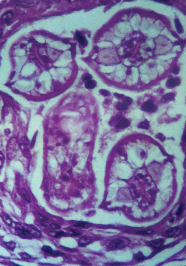 Cross-section of Baylisascaris procyonis larva in tissue section of brain, demonstrating characteristic diagnostic features including prominent lateral alae and excretory columns.