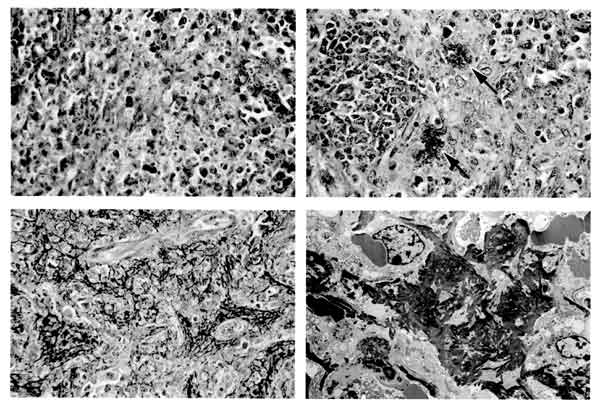 Sections of spleen from Ebola virus (EBOV)-infected animals. Top left, BALB/c mouse, note absence of polymerized fibrin (phosphotungstic acid [PTA] hematoxylin, original magnification X400). Field representative of five of five mice tested. Top right: guinea pig. Note discreet foci of polymerized fibrin (arrows) (PTA hematoxylin, original magnification X400). This field shows infrequent fibrin deposits; most fields in five of five animals examined showed no evidence of polymerized fibrin. Lower 
