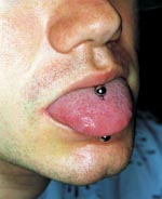 Thumbnail of The tongue pierce of the man from the case study. The stud was bispherical metal inserted without anesthesia or preparation. Although the stud was removable, the patient had not removed it. The area around insertion was clean with no local sign of infection when the stud was removed; the tongue was not inflamed or painful.