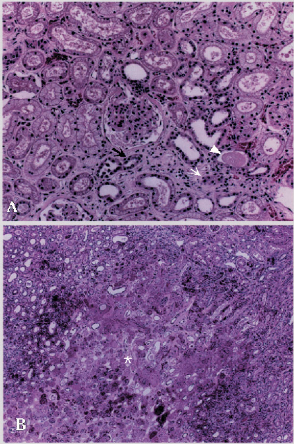 Histopathologic changes in kidney tissue from a patient with hemorrhagic fever with renal syndrome, Primorye region. Changes include interstitial edema with mild infiltration of mononuclear cells (small arrow) and degeneration of renal tubules (large arrow) in cortex. Proteinaceous casts and exudate (arrowhead) are seen in lumina of renal tubules (A). No apparent glomerular changes. Most prominent change in the medulla is well–defined necrotic lesion (asterisk) (B).