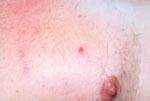 Thumbnail of Closer view of papulovesicular lesions on patient with rickettsialpox.