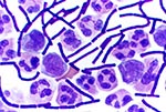Thumbnail of Gram stain of cerebrospinal fluid (Case 1) showing B. anthracis.