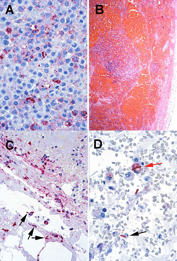 A. Pleural fluid cell block from a nonfatal case showing abundant Bacillus anthracis granular antigen staining inside mononuclear inflammatory cells. (Immunohistochemical assay with a mouse monoclonal anti-B. anthracis capsule antibody and detection with alkaline phosphatase and naphthol fast red, original magnification 158X). B. Mediastinal lymph node from a fatal case of anthrax showing extensive capsular and sinusoidal hemorrhage. (Hematoxylin and eosin, original magnification 25X). C. Lymph