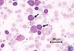 Thumbnail of Photomicrograph of a lymphocyte from a lymph node aspirate containing Ehrlichia morula (arrow). Stain is with Wright’s-Giemsa.