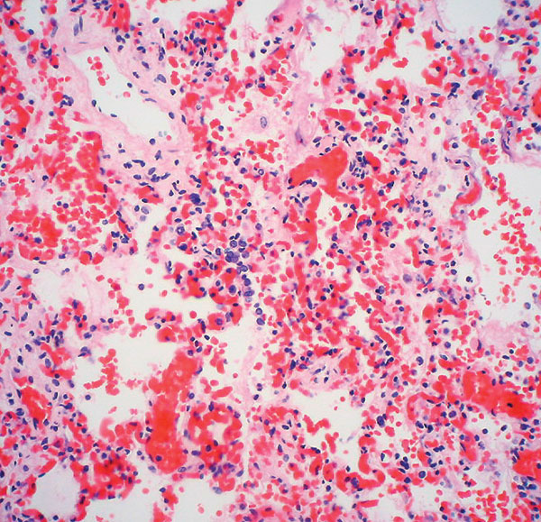 Interstitial pneumonitis in the 14-month-old girl who died of human enterovirus 71 disease. Photomicrograph shows alveolar wall congestion, intra-alveolar hemorrhage, and interstitial lymphocytic infiltrate. (Hematoxylin and eosin stain, original magnification x 200).