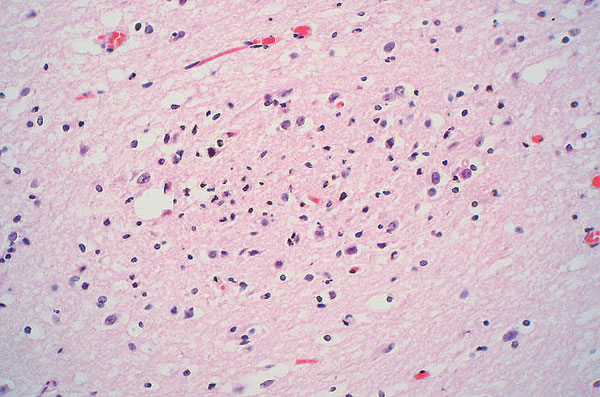 Section of brain showing a focus of necrosis. (Hematoxylin and eosin stain, original magnification x 200).