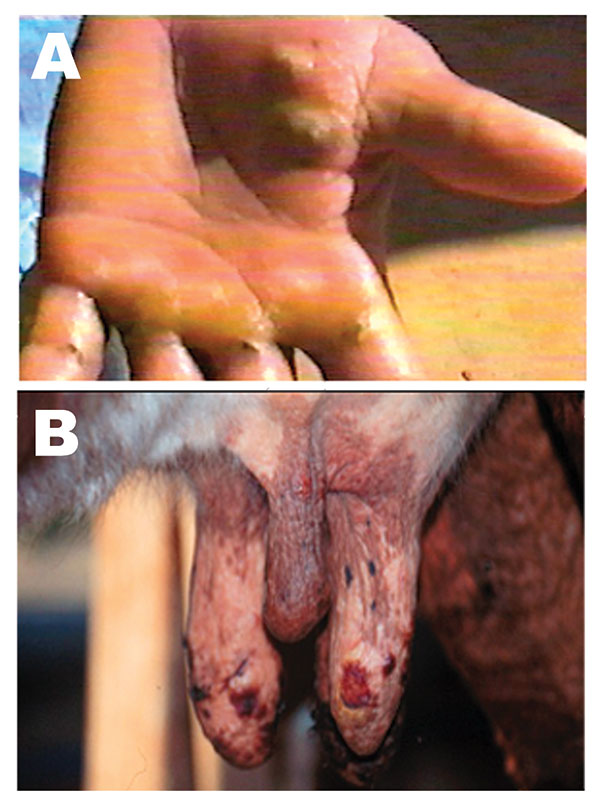 Lesions from suspected Araçatuba virus on hand of dairy farm worker (milker) (A) and teats of cow (B).