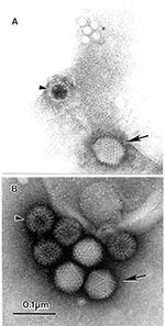 Thumbnail of The open view of diagnostic electron microscopy. A. Multiple agents observed in a fecal sample from a pediatric patient with diarrhea. A 10% suspension was prepared in distilled water, cleared by low-speed centrifugation followed by 5 minutes at 15,000 x g in a bench top centrifuge, and centrifuged directly to the grid using an Airfuge EM-90 rotor (Beckman, Palo Alto, CA): adenovirus-(→), incomplete rotavirus-particle (&gt;), and small round featureless particles, probably adeno-ass