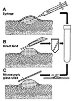 Thumbnail of Three methods for efficient collection of vesicular and blister fluids for diagnostic electron microscopic. A. The contents of a vesicle are collected into the barrel of a needle. B. After the blister is opened, a coated electron microscopic grid is touched to the fluid and air-dried (direct electron microscopic). C. A glass microscope slide is touched directly to an unroofed lesion and a smear prepared. Samples are then placed in rigid containers for transport to the electron micro