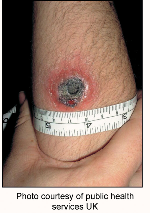 Suspected cutaneous anthrax lesion from a patient in the United Kingdom. Photos like this, transmitted by e-mail, enabled clinical experts to review images of suspected cases worldwide and provide rapid assistance.