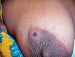 Thumbnail of Eschar on the breast of a patient with scrub typhus during an outbreak on Darnley Island, Torres Strait.