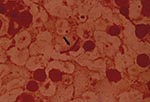 Thumbnail of Anthrax bacilli (arrow) within mesenteric lymph node tissue.