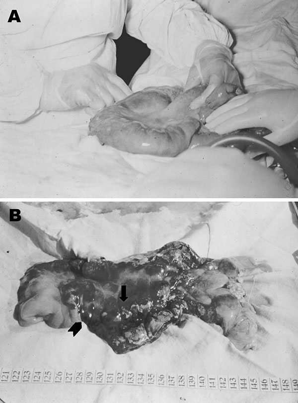 A. Severe edema of a small bowel loop in intestinal anthrax with a large mesenteric lymph node held between the surgeon’s fingers. B. Same segment of bowel opened after resection. Edema, necrosis, and mucosal hemorrhages exist. A central eschar (arrow) and small surrounding nodules (arrowhead) are reminiscent of the cutaneous lesions of anthrax.