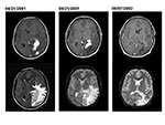 Thumbnail of Axial MRI (magnetic resonance imaging) from patient 2 obtained when first seen in Peru (April 21, 2001), before surgical biopsy in the United States (September 21, 2001), and 7 months after start of treatment (June 7, 2002). The top images are postgadolinium-enhanced, T1-weighted images, which demonstrate resolution of one of the irregular areas of enhancement over time. The bottom images are T2-weighted images (image from April 21 is from a fluid attenuated inversion recovery [FLAI