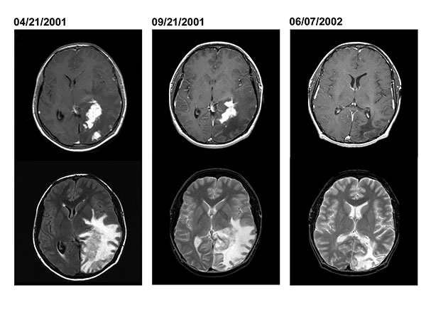 Axial MRI (magnetic resonance imaging) from patient 2 obtained when first seen in Peru (April 21, 2001), before surgical biopsy in the United States (September 21, 2001), and 7 months after start of treatment (June 7, 2002). The top images are postgadolinium-enhanced, T1-weighted images, which demonstrate resolution of one of the irregular areas of enhancement over time. The bottom images are T2-weighted images (image from April 21 is from a fluid attenuated inversion recovery [FLAIR] sequence),