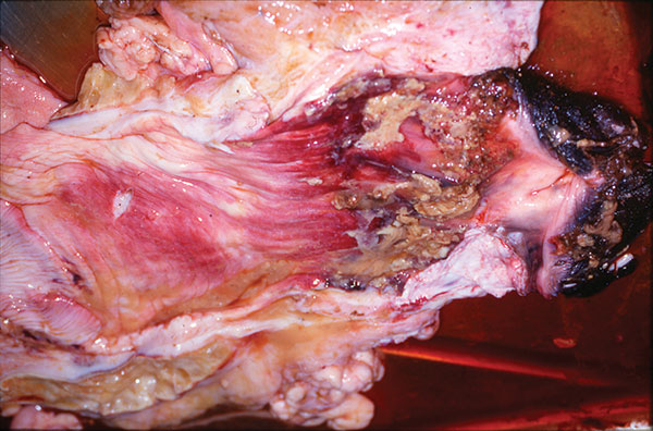 Pathologic lesions of the vagina; note involvement primarily of caudal region.
