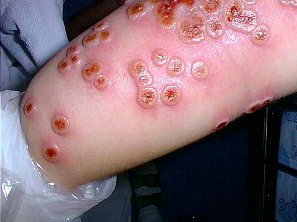 Cowpox lesions on patient’s forearm on day 7 after onset of illness.