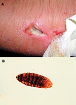 Thumbnail of Exit site wound on patient’s arm (a) and a maggot, measuring 16 mm in length, from patient’s wound (b).